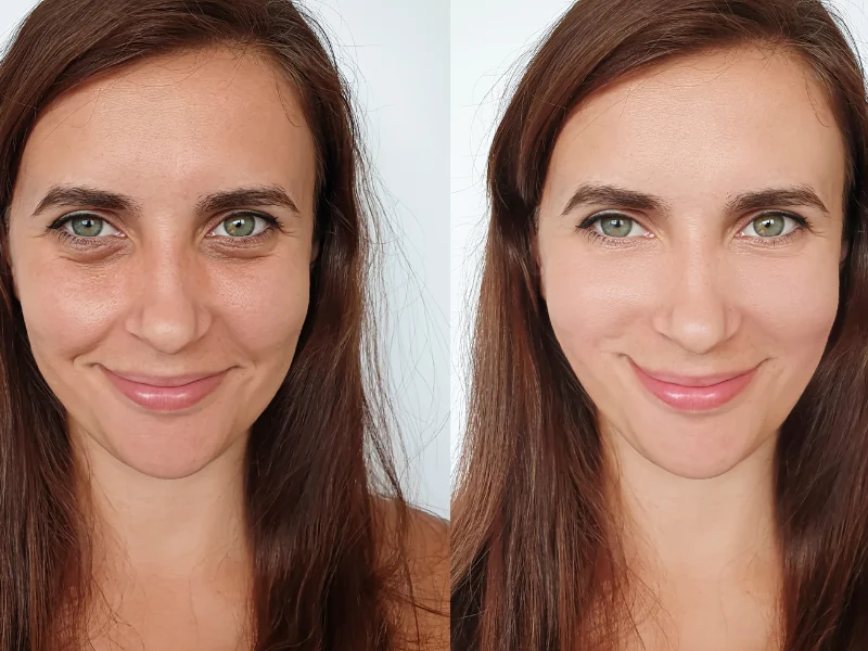 radiesse vs sculptra before and after