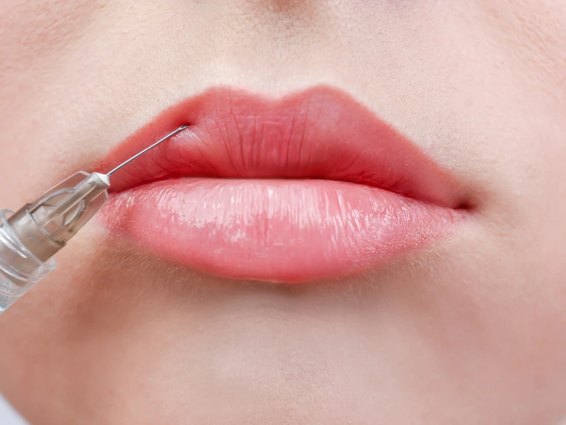 ideal candidate for lip fillers