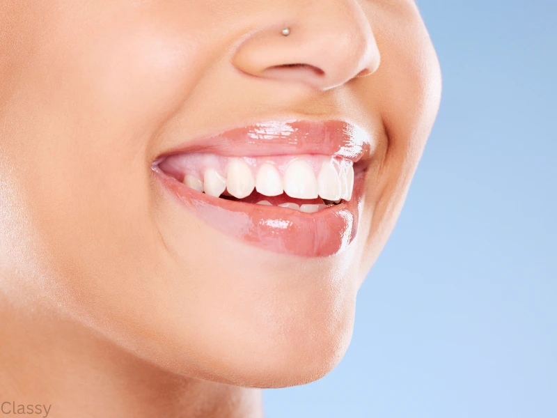 rha filler before and after