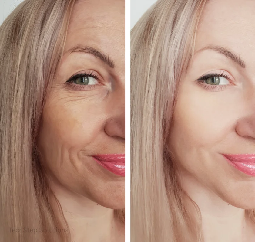 before and after dermal fillers