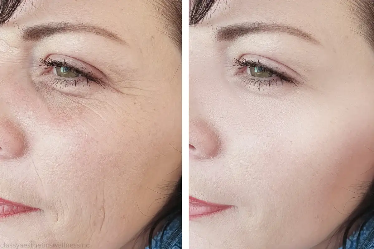botox before and after