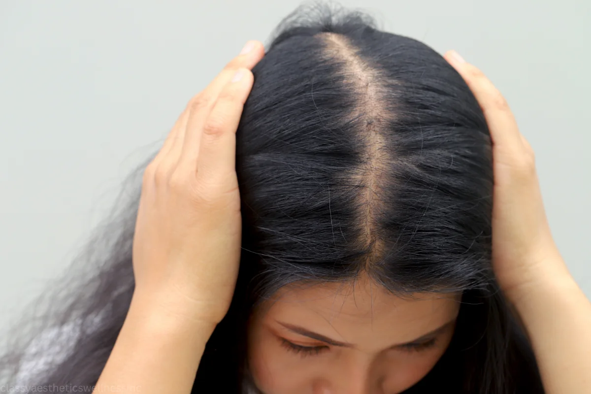 hair loss tirzepatide