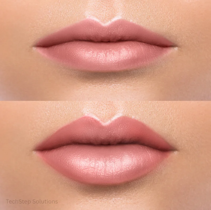 lip filler before after