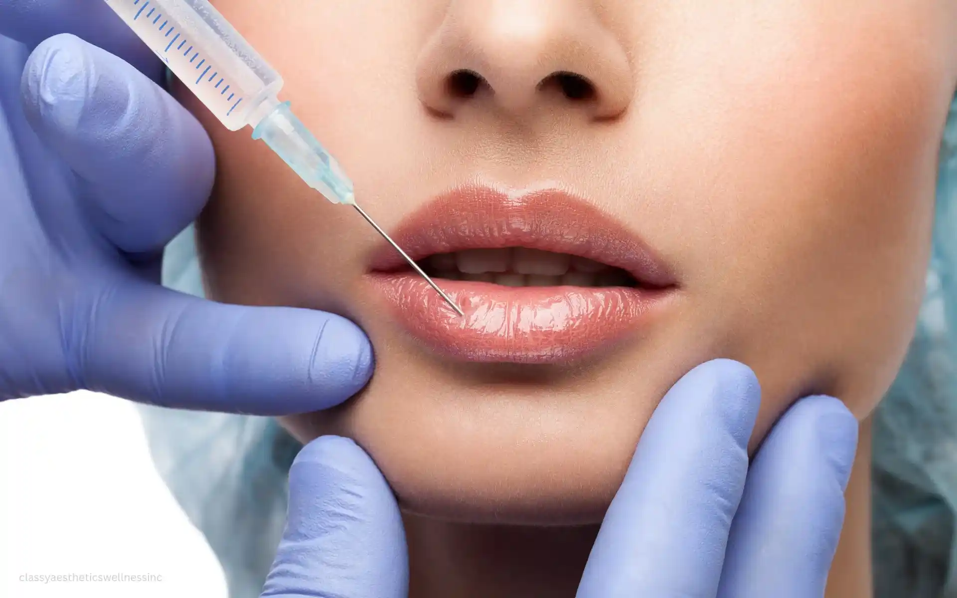 dermal fillers vs botox