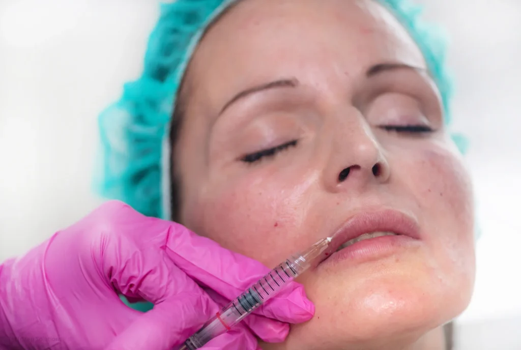 how long does it take for lip filler to settle